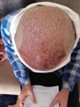 Hair-implants-turkey (9)