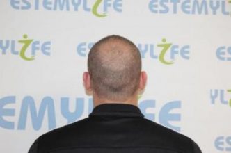 before-hair-transplant (1)