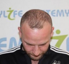 before-hair-transplant (3)