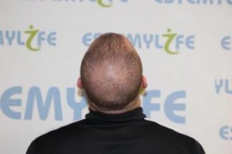 before-hair-transplant (4)