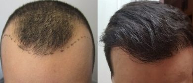 best-hair-loss-treatment