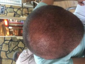 best hair transplant in istanbul (10)