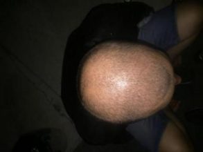 best hair transplant in istanbul (11)