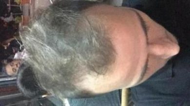 best-hair-transplant-in-istanbul