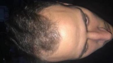 best hair transplant in istanbul (13)
