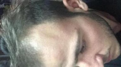 best hair transplant in istanbul (14)