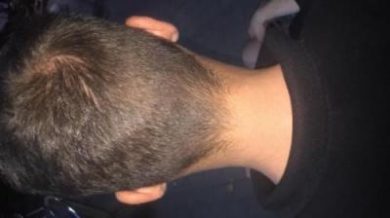 best hair transplant in istanbul (15)