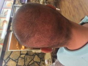 best hair transplant in istanbul (16)