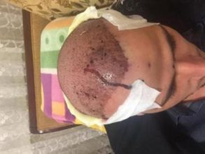 best hair transplant in istanbul (17)