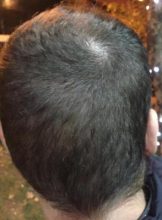 best hair transplant in istanbul (18)