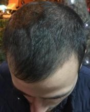 best hair transplant in istanbul (19)