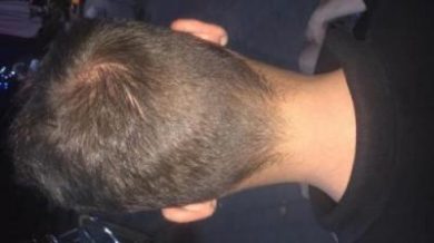 best hair transplant in istanbul (2)