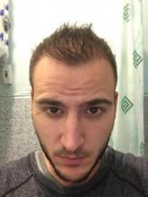 best hair transplant in istanbul (24)