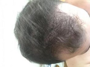 best hair transplant in istanbul (3)