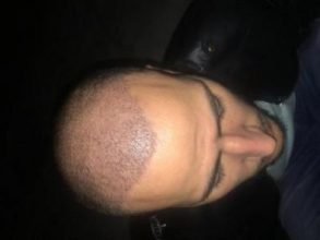 best hair transplant in istanbul (5)