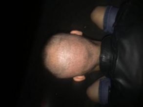 best hair transplant in istanbul (6)