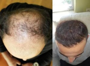 best-hair-transplant-in-turkey (1)