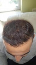 best-hair-transplant-in-turkey (10)