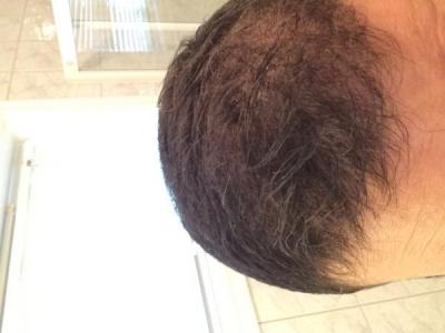 best-hair-transplant-in-turkey (14)