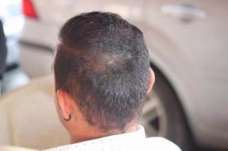 best-hair-transplant-in-turkey (14)