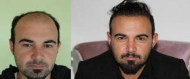 best-hair-transplant-in-turkey (16)
