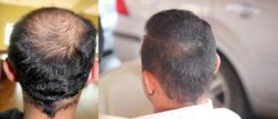 best-hair-transplant-in-turkey (2)