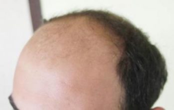 best-hair-transplant-in-turkey (3)