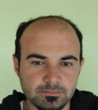 best-hair-transplant-in-turkey (4)