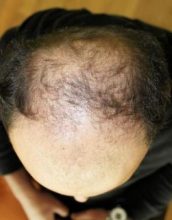 best-hair-transplant-in-turkey (5)