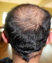 best-hair-transplant-in-turkey (6)