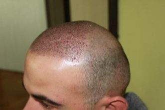best-hair-transplant-in-turkey (7)