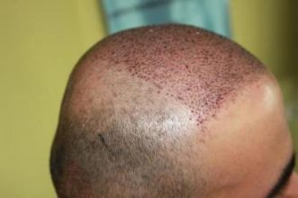 best-hair-transplant-in-turkey (8)