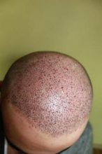 best-hair-transplant-in-turkey (9)