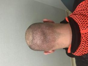best-hair-transplant-turkey (1)