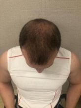 best-hair-transplant-turkey (11)