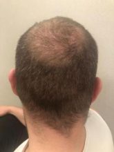 best-hair-transplant-turkey (12)
