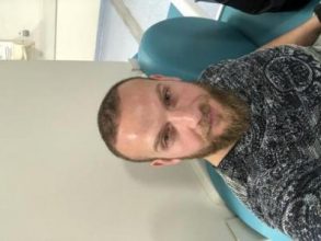 best-hair-transplant-turkey (13)