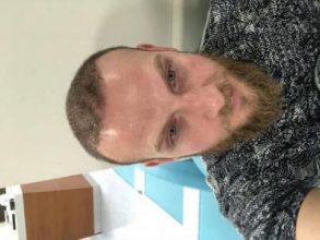 best-hair-transplant-turkey (14)