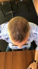 best-hair-transplant-turkey (18)