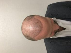 best-hair-transplant-turkey (2)