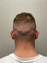 best-hair-transplant-turkey (20)
