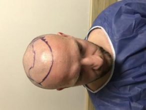 best-hair-transplant-turkey (21)