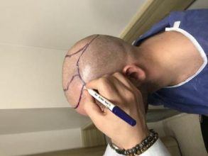 best-hair-transplant-turkey (21)