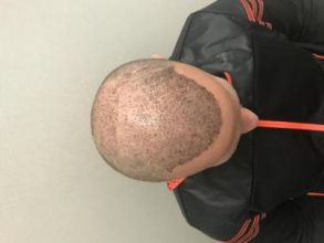 best-hair-transplant-turkey (21)