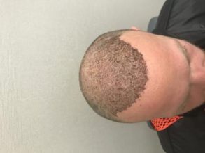 best-hair-transplant-turkey (25)
