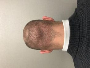 best-hair-transplant-turkey (3)