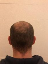 best-hair-transplant-turkey (4)