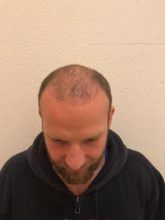 best-hair-transplant-turkey (5)