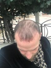 best-hair-transplant-turkey (9)