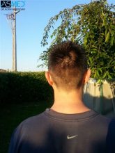 fue-hair-transplant-cost-turkey (1)